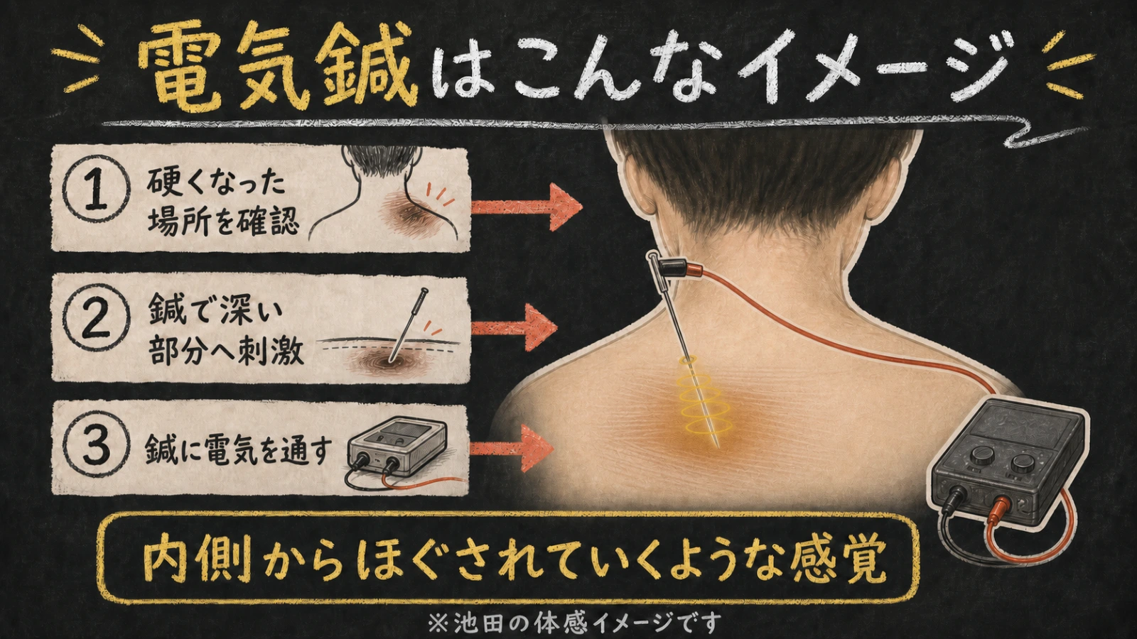 首肩の硬くなった場所を確認し、鍼で深い部分へ刺激して電気を通すという、筆者の体感イメージを示した図