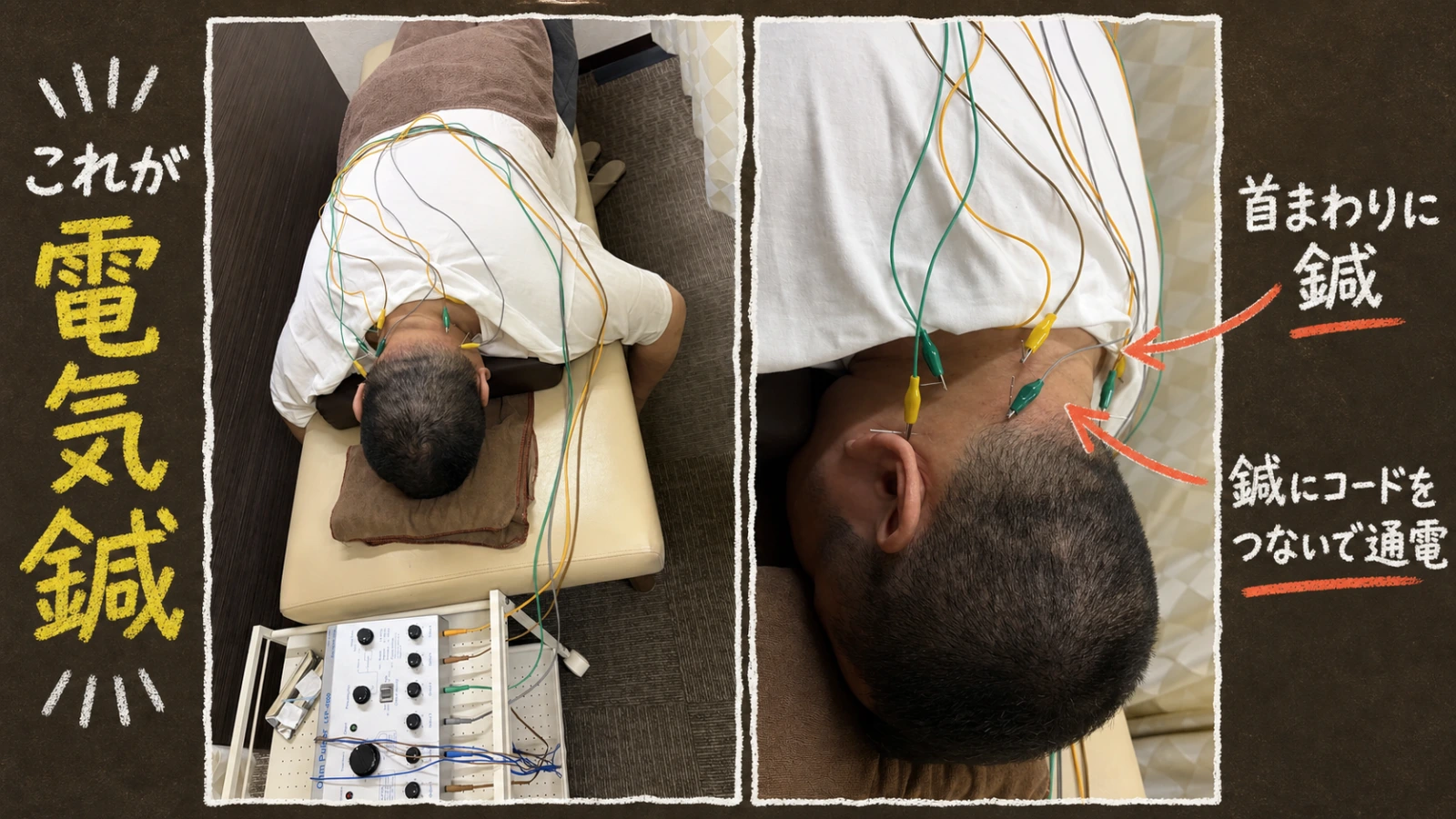 筆者が首まわりに鍼を受け、鍼へ通電用コードが接続されている様子を2枚並べた写真コラージュ